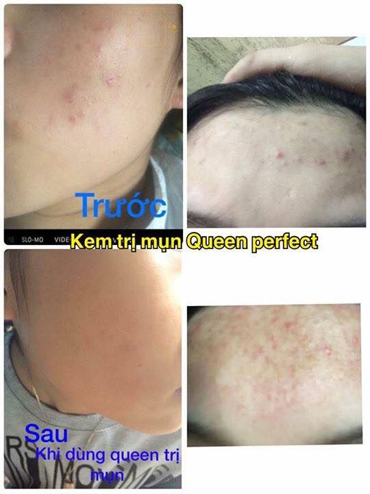 Kem đặc trị Mụn Queen Perfect hiệu quả sau 3-5 ngày