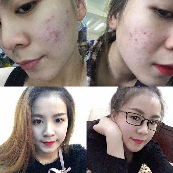 Kem đặc trị Mụn Queen Perfect hiệu quả sau 3-5 ngày