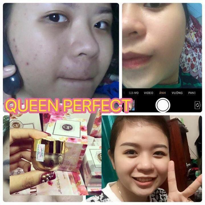 Kem đặc trị Mụn Queen Perfect hiệu quả sau 3-5 ngày