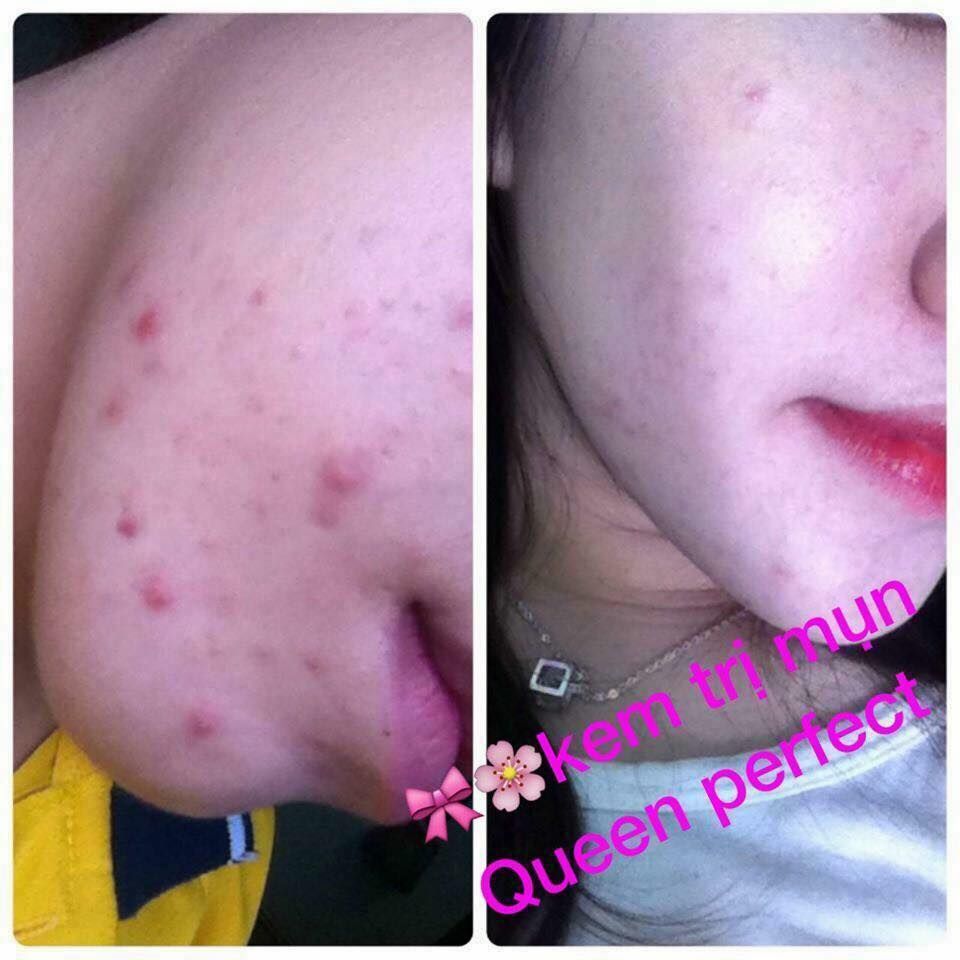 Kem đặc trị Mụn Queen Perfect hiệu quả sau 3-5 ngày