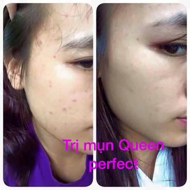Kem đặc trị Mụn Queen Perfect hiệu quả sau 3-5 ngày