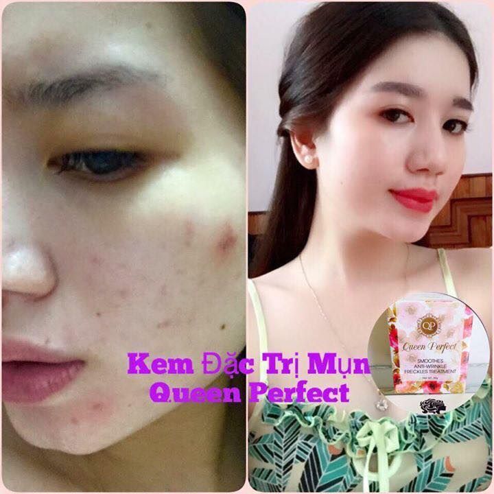 Kem đặc trị Mụn Queen Perfect hiệu quả sau 3-5 ngày