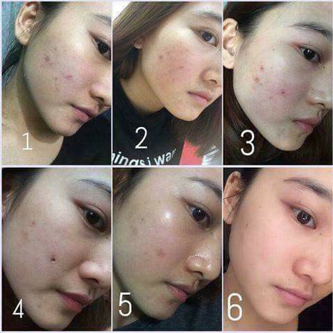 Kem đặc trị Mụn Queen Perfect hiệu quả sau 3-5 ngày