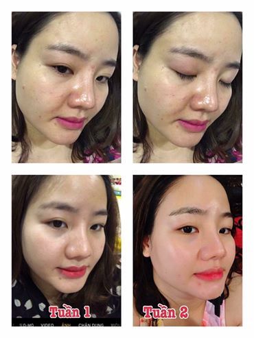 Kem đặc trị Mụn Queen Perfect hiệu quả sau 3-5 ngày