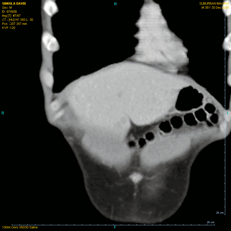 Liver MRI Animated Image