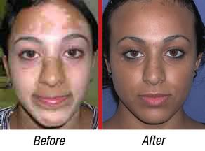 Skin pigmentation steroid cream