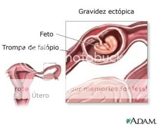 gravidez ectópica ou gravidez nas trompas